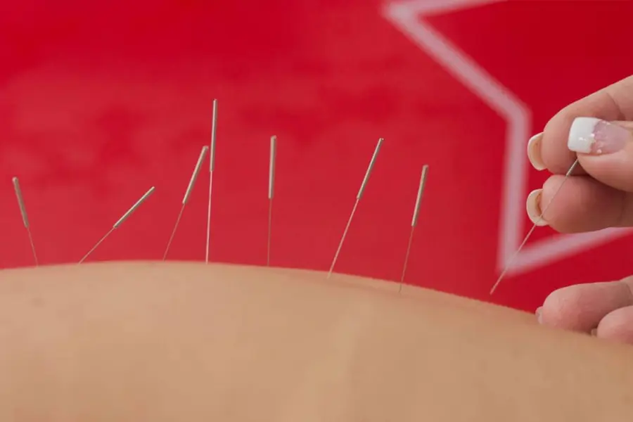 Sessão de acupuntura nas costas
